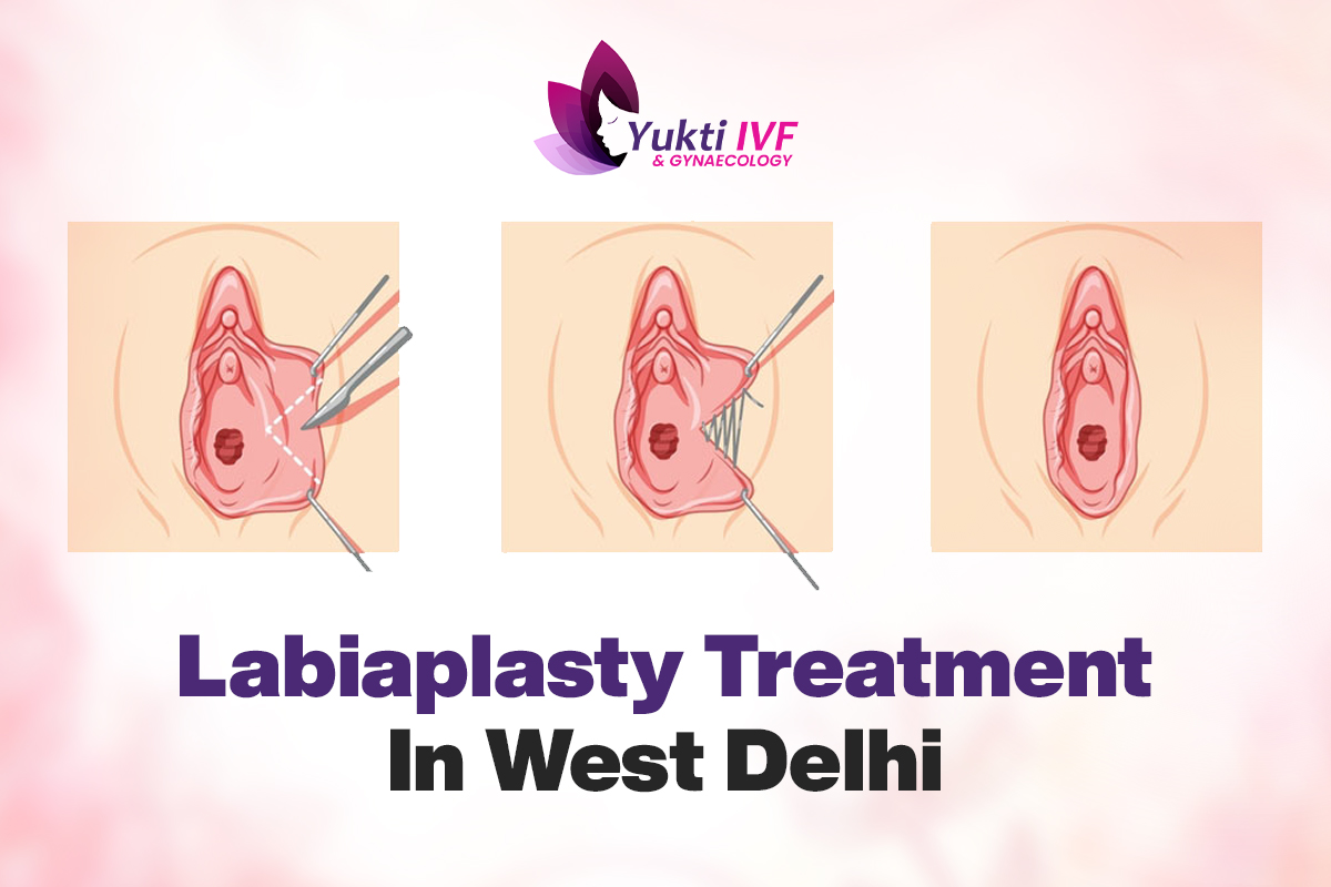 labiaplasty treatment in west delhi